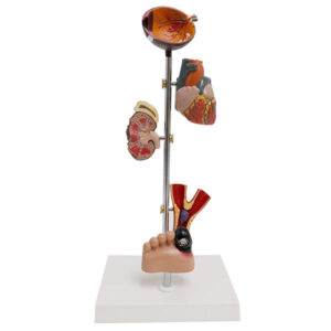 Modelo diabetes tipo II