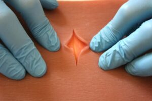 Patch de sutura premium - 3 camadas